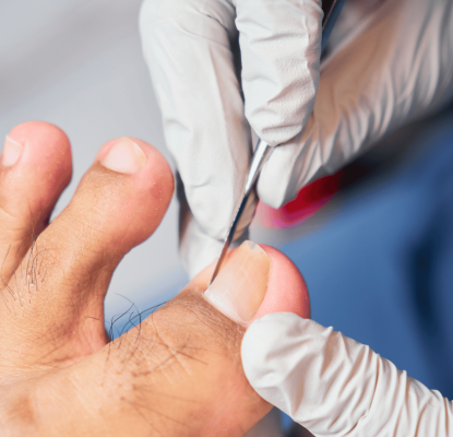 Observation, Treatment and Result for an Ingrown Toenail